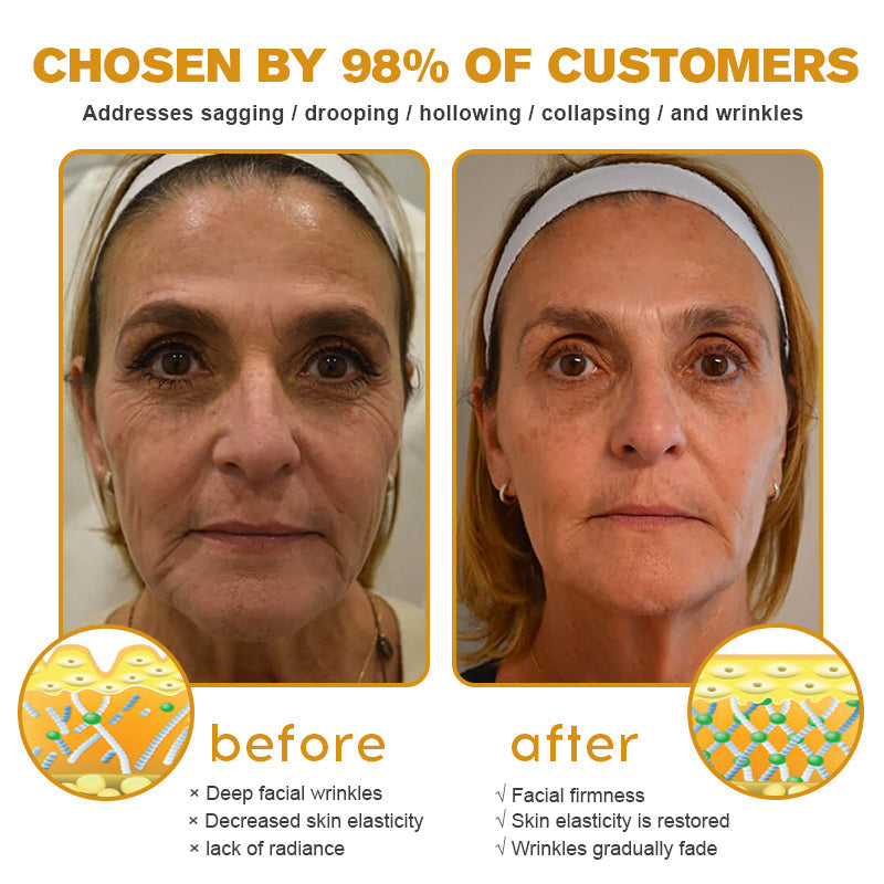 Last Day Promotion 80% OFF - ✨Furzero™ Bee Venom Wrinkle Removal Cream