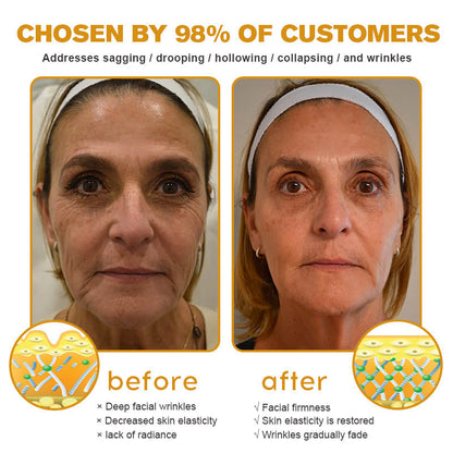 Last Day Promotion 80% OFF - ✨Furzero™ Bee Venom Wrinkle Removal Cream